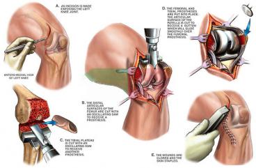 Knee Replacement